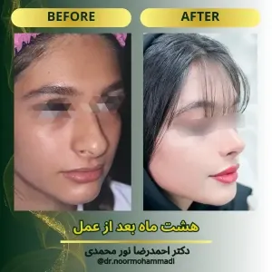 rhinoplasty-1