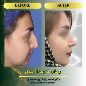 rhinoplasty-10