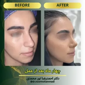 rhinoplasty-11