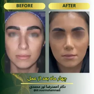 rhinoplasty-12
