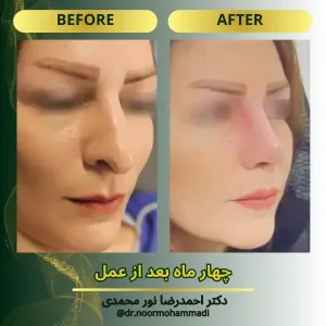 rhinoplasty-13