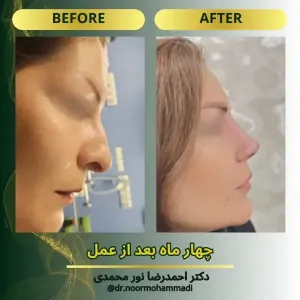 rhinoplasty-14