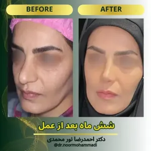 rhinoplasty-15