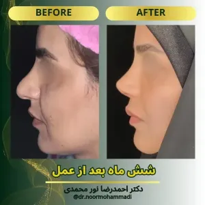rhinoplasty-16