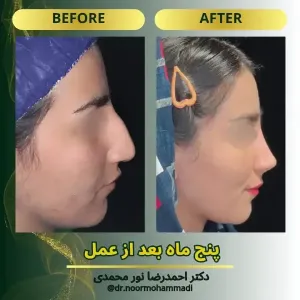rhinoplasty-17
