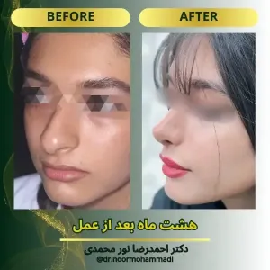 rhinoplasty-2