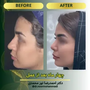 rhinoplasty-3