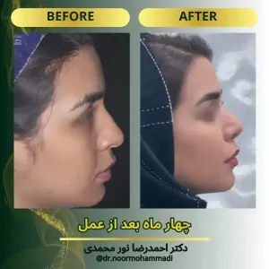 rhinoplasty-4