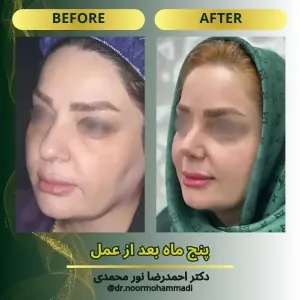 rhinoplasty-5