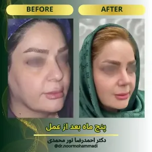 rhinoplasty-6