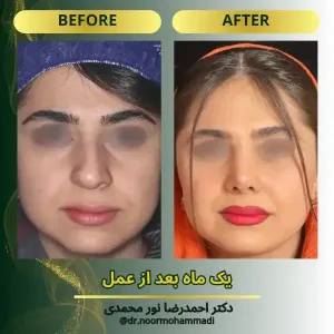 rhinoplasty-7