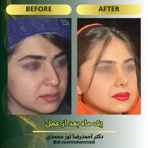 rhinoplasty-8