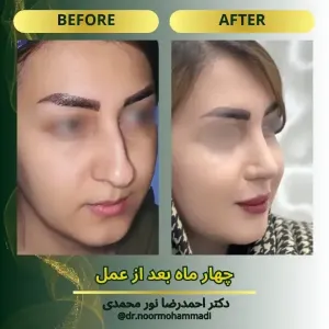 rhinoplasty-9