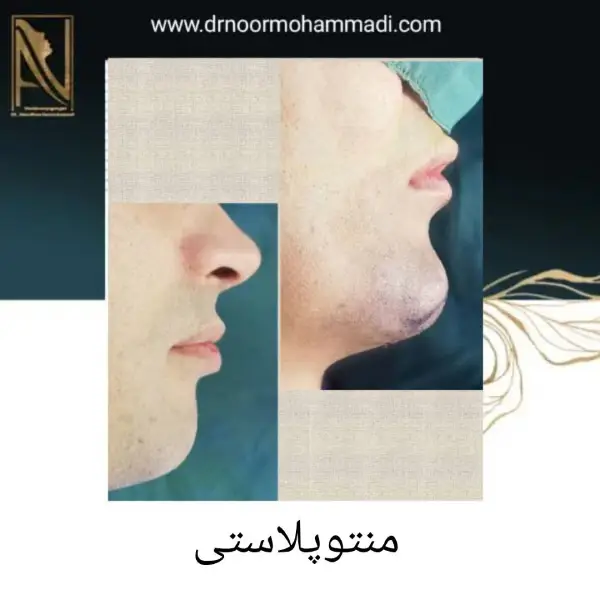 عمل منتوپلاستی در تهران _ دکتر احمدرضا نورمحمدی