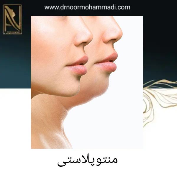 عمل زیبایی چانه در تهران _ دکتر احمدرضا نورمحمدی