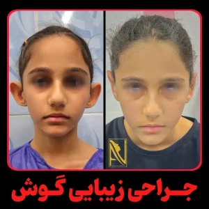 عمل زیبایی گوش در تهران _ دکتر احمدرضا نورمحمدی