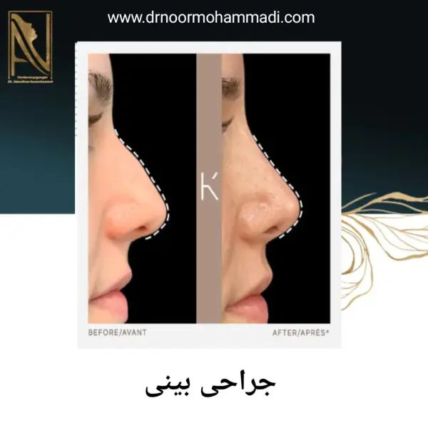 جراحی زیبایی بینی در تهران _ دکتر احمدرضا نورمحمدی