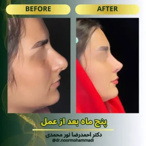 نمونه کار رینوپلاستی در تهران _ دکتر احمدرضا نورمحمدی