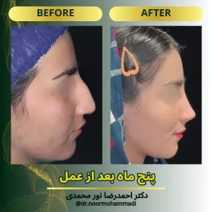 نمونه کار عمل بینی در تهران _ دکتر احمدرضا نورمحمدی