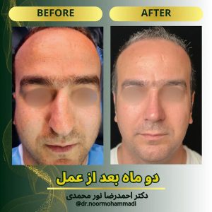 عمل بینی طبیعی مردانه در تهران _ دکتر احمدرضا نورمحمدی