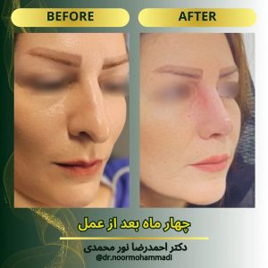 جراحی بینی طبیعی در تهران _ دکتر احمدرضا نورمحمدی