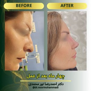 جراحی بینی طبیعی _ دکتر احمدرضا نورمحمدی