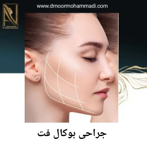 جراحی بوکال فت _ دکتر احمدرضا نورمحمدی