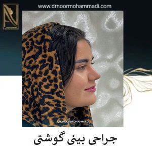 قبل و بعد جراحی بینی گوشتی در تهران _ دکتر احمدرضا نورمحمدی