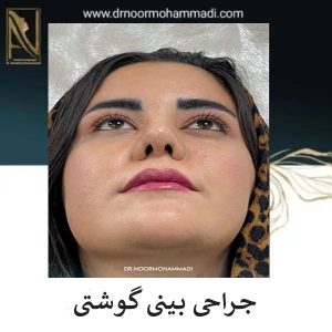 نمونه کار جراحی بینی گوشتی در تهران _ دکتر احمدرضا نورمحمدی