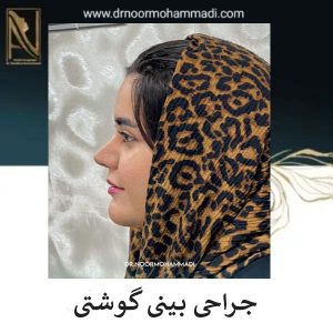 عمل بینی گوشتی در تهران _ دکتر احمدرضا نورمحمدی