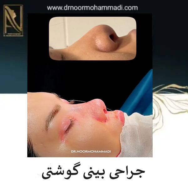 جراحی بینی گوشتی در تهران _ دکتر احمدرضا نورمحمدی