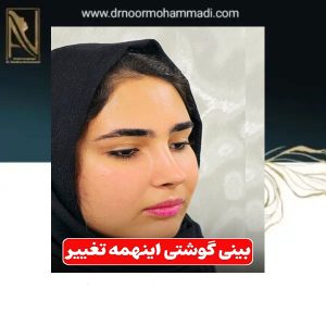 نمونه کار بهترین جراح بینی در تهران _ دکتر احمدرضا نورمحمدی