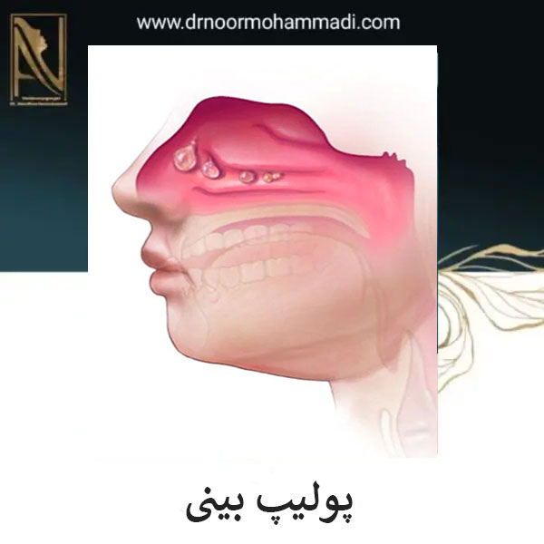 پولیپ بینی چیست _ دکتر احمدرضا نورمحمدی
