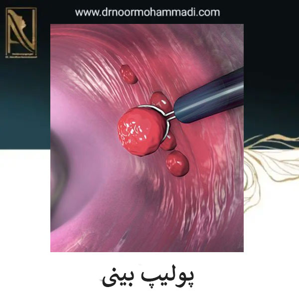 علائم پولیپ بینی _ دکتر احمدرضا نورمحمدی