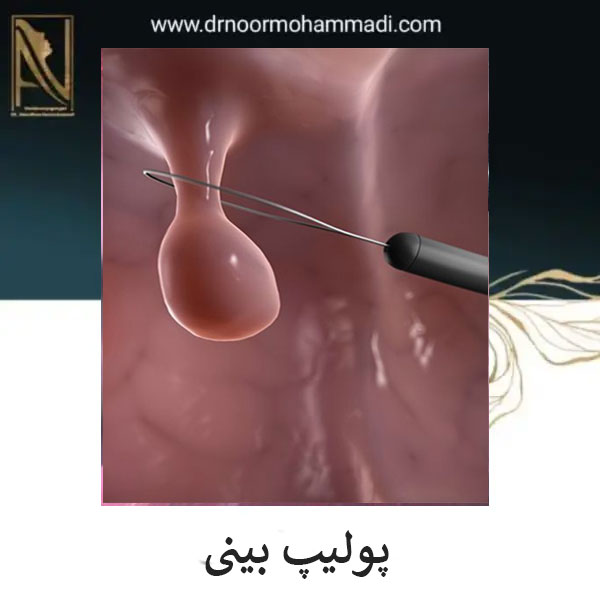 درمان پولیپ بینی _ دکتر احمدرضا نورمحمدی