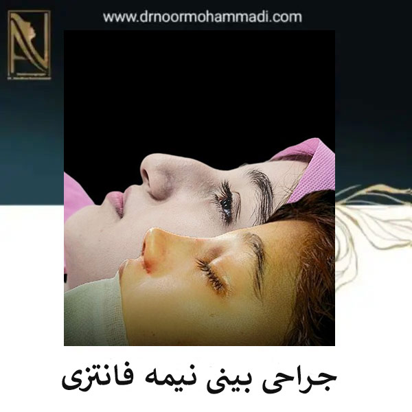 جراحی بینی نیمه فانتزی _ دکتر احمدرضا نورمحمدی