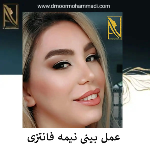 رینوپلاستی نیمه فانتزی _ دکتر احمدرضا نورمحمدی