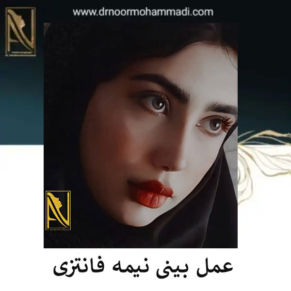 نمونه کار عمل بینی نیمه فانتزی _ دکتر احمدرضا نورمحمدی